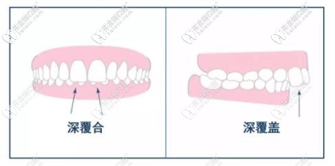 深覆合和深覆盖的区别图片 深覆合和深覆盖的区别图片