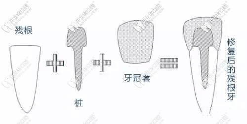 烂牙根修复后图示 烂牙根修复后图示
