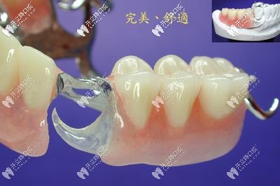 干货来了：同为临时牙冠的即刻义齿和临时义齿有区别吗？