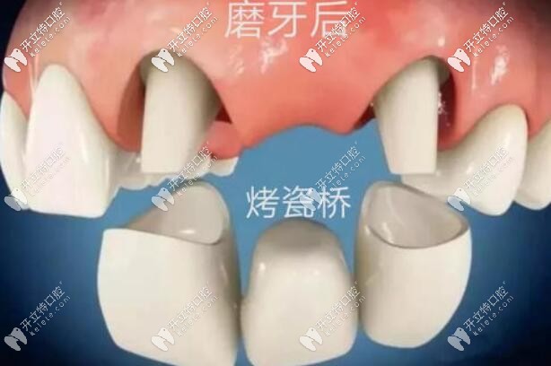 烤瓷桥图解 烤瓷桥图解