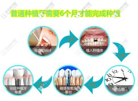 种植牙过程图解 种植牙过程图解