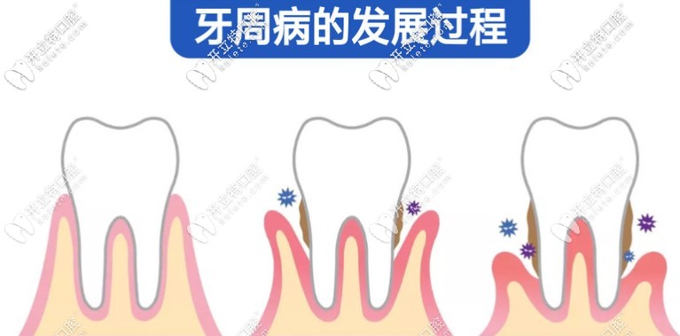 龈下刮治疼吗