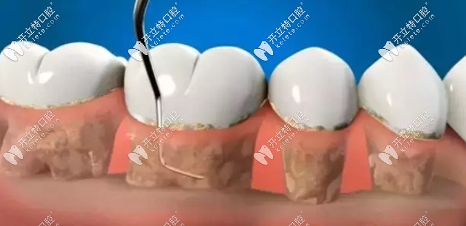 龈下刮治对牙龈有伤害吗
