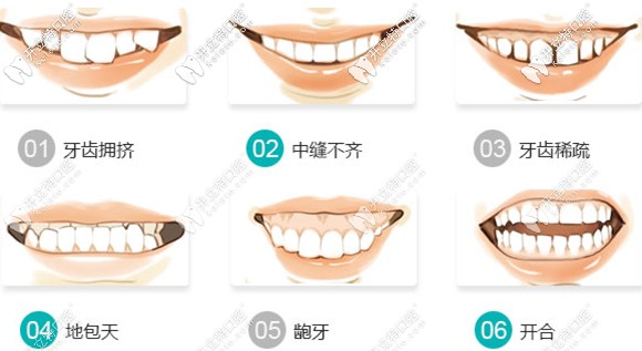 在温州艺星口腔简单矫正病例6980元起