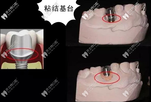 粘结基台的临床应用 粘结基台的临床应用