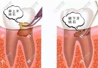 洗牙竟然还要把牙龈翻开洗?这是神马操作!