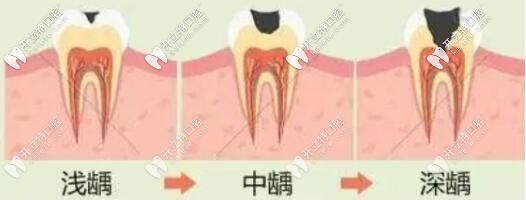 牙齿的龋坏程度选择嵌体材料 牙齿的龋坏程度选择嵌体材料