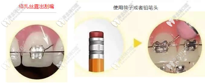 金属牙套的钢丝扎嘴怎么办 金属牙套的钢丝扎嘴怎么办