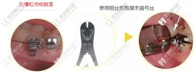 牙齿矫正中托槽松动脱落怎么办 牙齿矫正中托槽松动脱落怎么办
