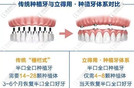 传统种植牙与立得用种植牙区别