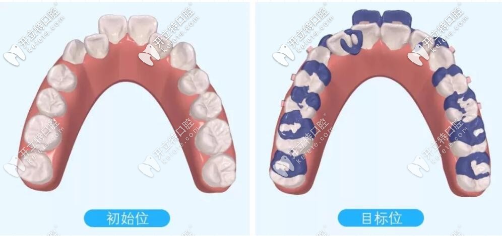 磨牙后推示意图 磨牙后推示意图