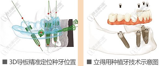 立得用种植牙技术示意图