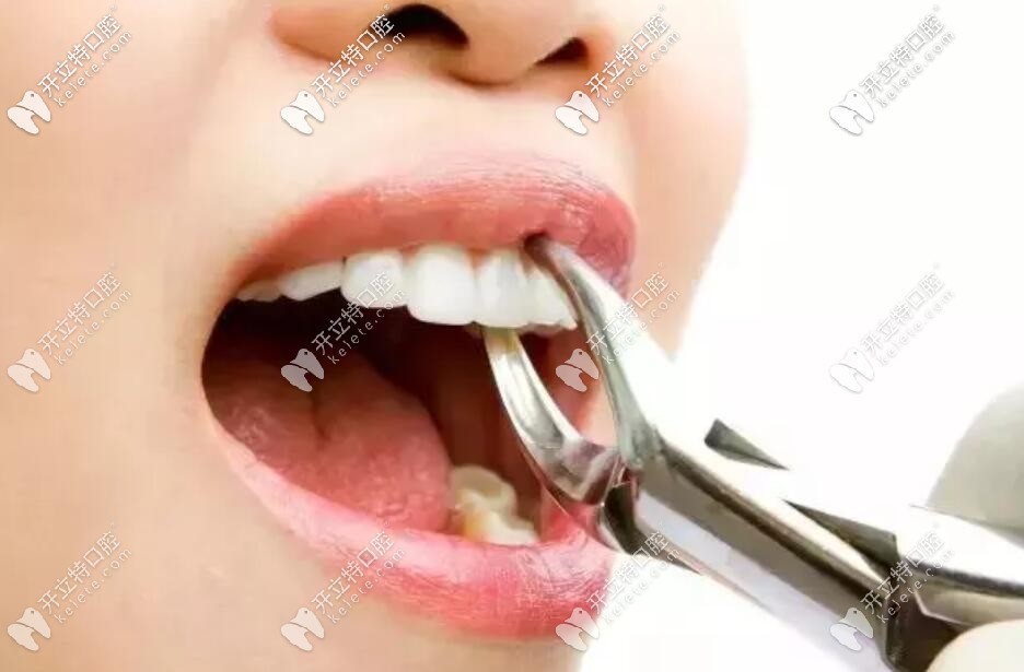 拔牙 拔牙
