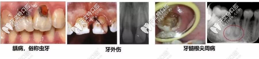 常见的牙体牙髓疾病