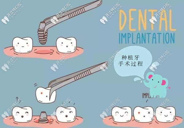 微创种植牙手术过程图解 微创种植牙手术过程图解