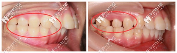 推磨牙的优势在于减少了拔牙矫正的概率