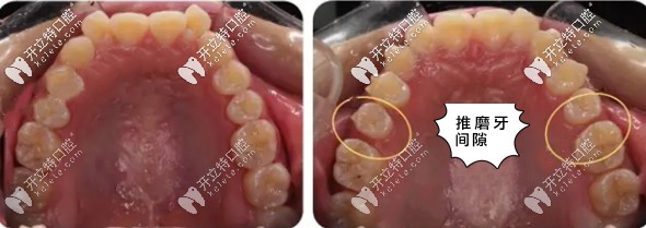 隐适美磨牙后推的矫正案例图