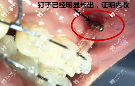 你们都在意正畸种植钉的作用,而我更关心打骨钉什么感觉