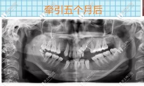 埋伏牙开窗牵引5个月后