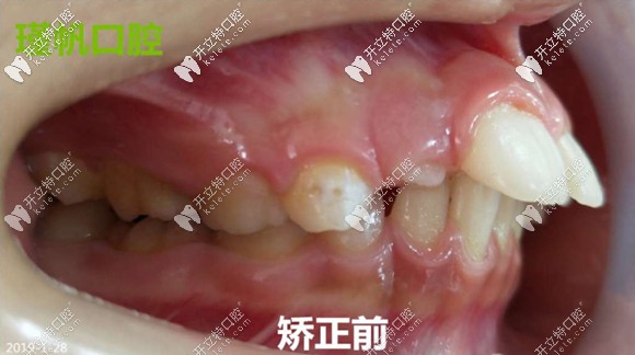 骨性龅牙侧面图片