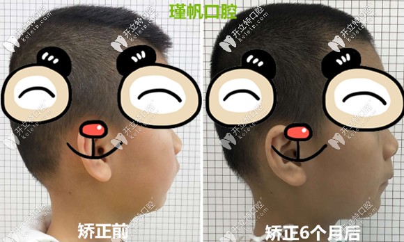 桂林瑾帆口腔7岁小孩换牙后成了龅牙,戴活动矫正器半年后终于初见成效