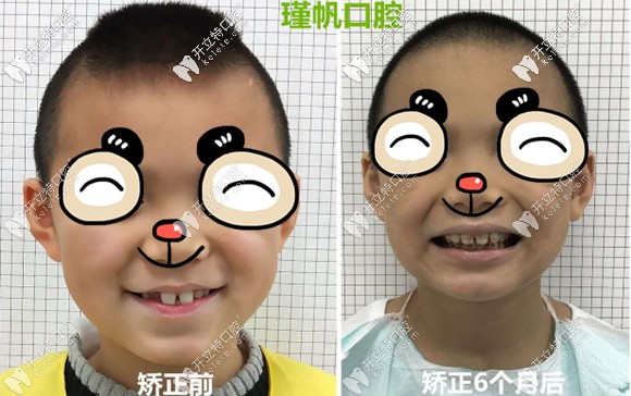 小孩换牙后龅牙矫正前后效果