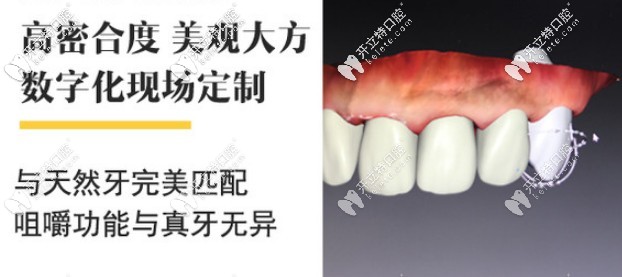 泽康、威兰德、吉尔巴赫全瓷牙该选哪个牌子 泽康、威兰德、吉尔巴赫全瓷牙该选哪个牌子