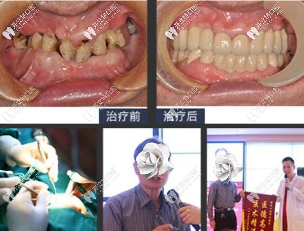 8旬老人在广州德系口腔做全口种植牙前后照片