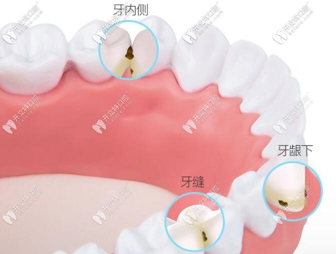 冲牙器能深入清理出牙缝的污垢