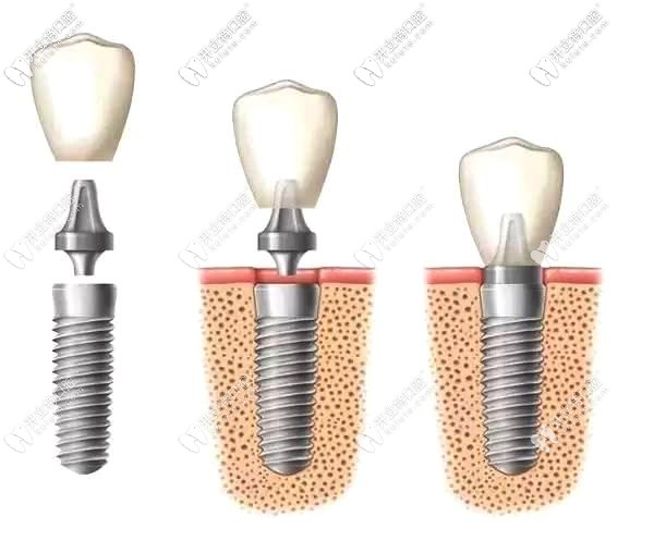 种植体埋入牙槽骨过程
