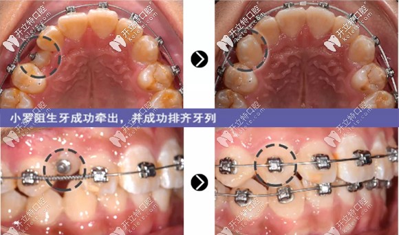 治疗8个月，阻生牙成功牵出并成功排齐牙列