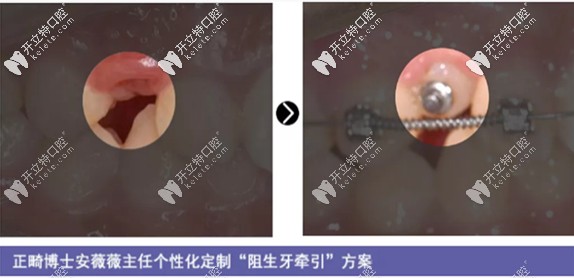 12岁孩子的阻生牙牵引加正畸案例