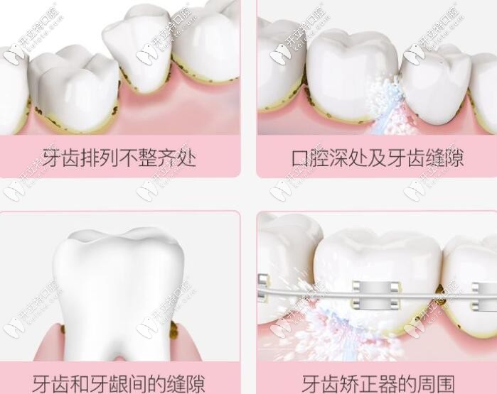 冲牙器怎么用 冲牙器怎么用