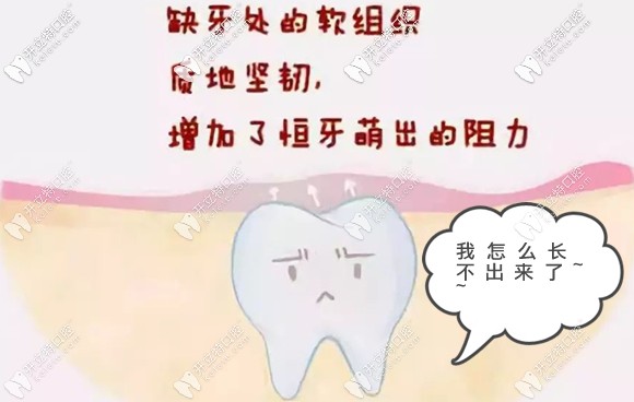 做阻生牙牵引术成功率高吗