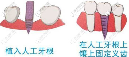 种植牙是需要植入人工牙根里的
