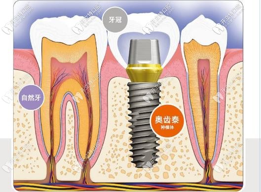 奥齿泰种植体外观