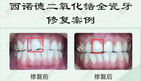 西诺德二氧化锆全瓷牙修复门牙案例 西诺德二氧化锆全瓷牙修复门牙案例