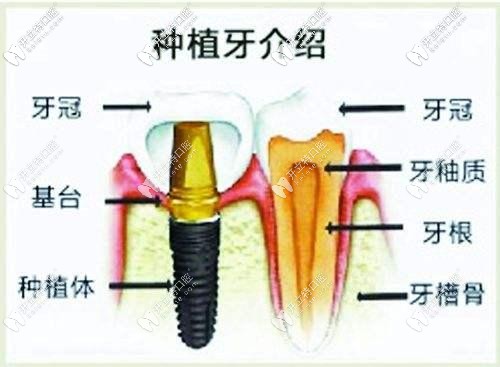 种植体和真牙的对比