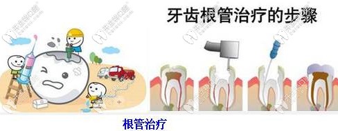 牙齿根管治疗的步骤