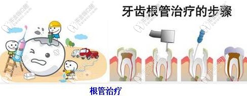 牙齿根管治疗的步骤 牙齿根管治疗的步骤