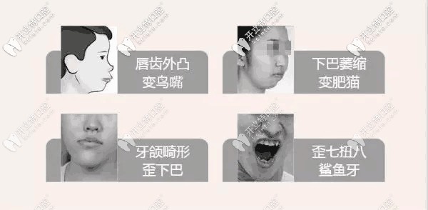 牙齿畸形几种情况 牙齿畸形几种情况