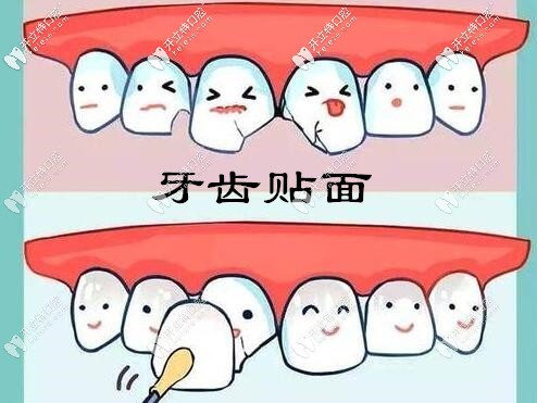 牙齿瓷贴面美白 牙齿瓷贴面美白