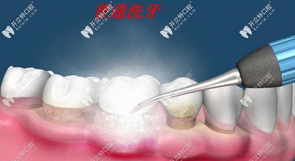 深度洗牙在口腔医学叫龈下刮治