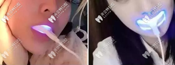 美牙仪会导致牙龈萎缩 美牙仪会导致牙龈萎缩