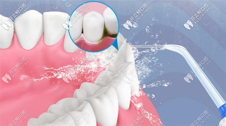 水牙线的害处是牙医不推荐水牙线的主要原因吗