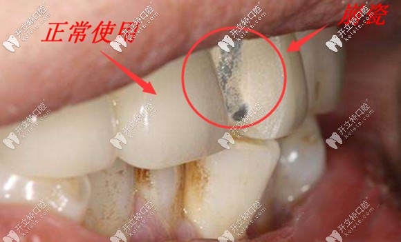 牙冠的合理设计也是影响使用寿命的重要因素 牙冠的合理设计也是影响使用寿命的重要因素