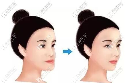 牙齿矫正和瘦脸没关系