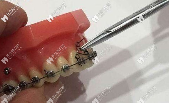 直丝弓矫正器示意图