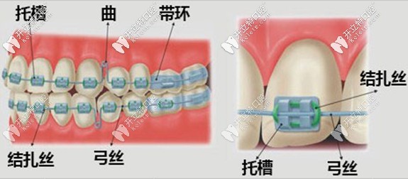 合理地选择和替换槽沟内的弓丝才是获得治疗效果的关键。