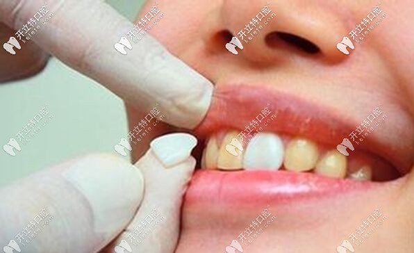 牙齿贴面下牙是否有必要做呢